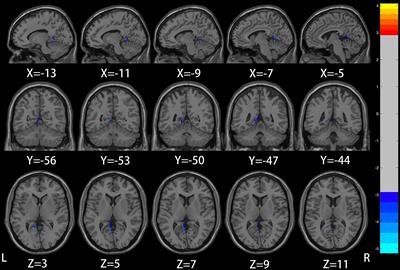 Alteration of whole-brain amplitude of low-frequency fluctuation and degree centrality in patients with mild to moderate depression: A resting-state functional magnetic resonance imaging study